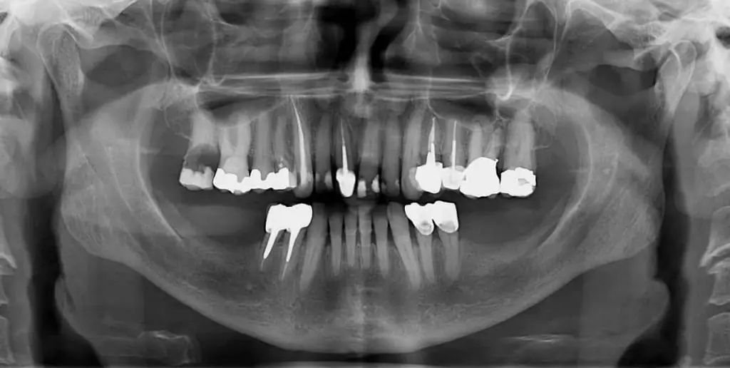 A panoramic dental X-ray showing completed restorative work